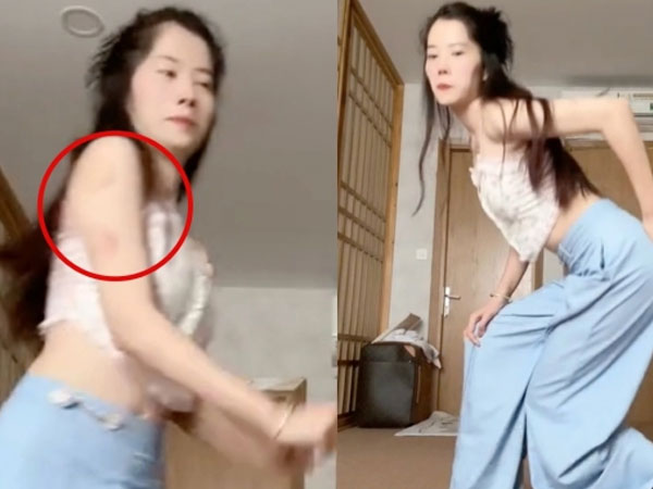 Nam Em tự đăng clip tập nhảy với biểu hiện bất ổn, loạt vết bầm trên tay gây chú ý