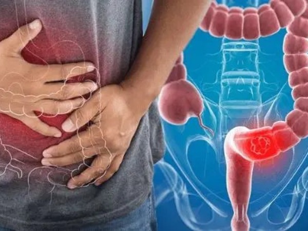 Ai dễ mắc ung thư đại trực tràng?