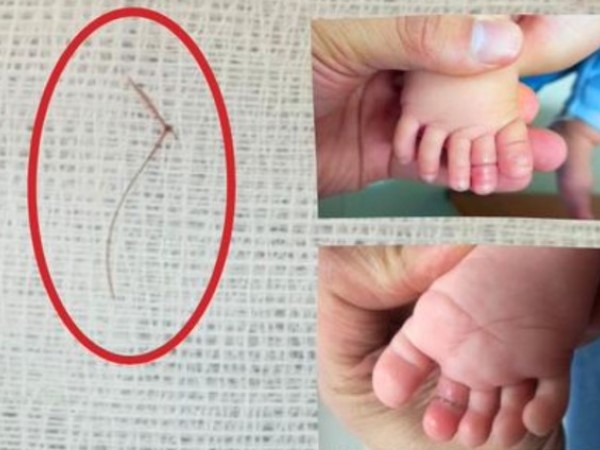 Sợi tóc thắt vào chân, bé gái 4 tháng tuổi suýt mất ngón