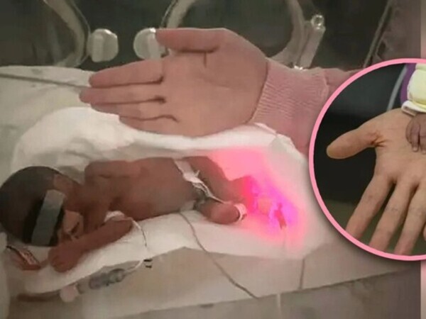Kỳ tích em bé chỉ nặng 6 lạng, nhỏ bằng lòng bàn tay người lớn, sống sót sau 4 tháng nguy kịch