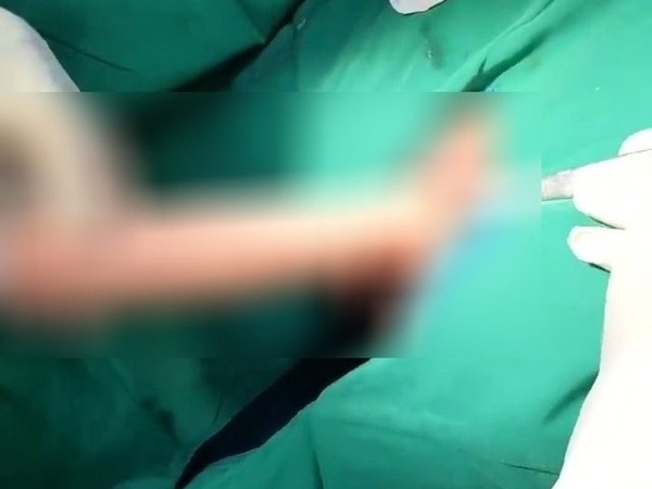 Nam thanh niên mắc kẹt dương vật giả trong trực tràng