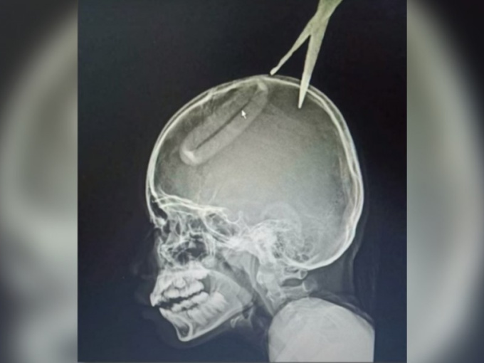 Bắt chước phim hành động, bé trai 4 tuổi ném kéo găm vào đầu chị gái