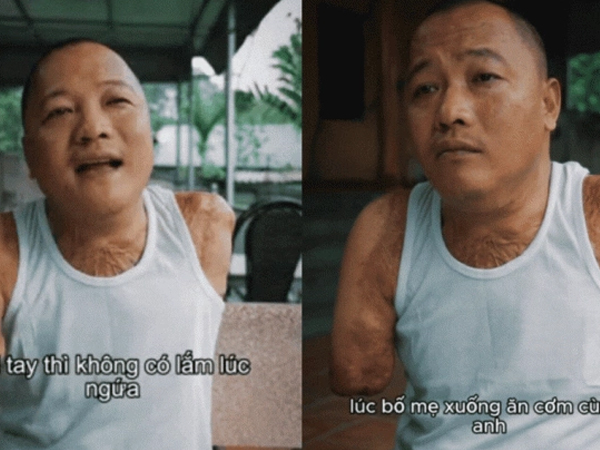 Người đàn ông bị điện giật phải cắt cụt tay chân, cay đắng khi vợ bỏ đi không lời từ biệt: 'Phải nhờ bố mẹ xúc cho từng miếng cơm'