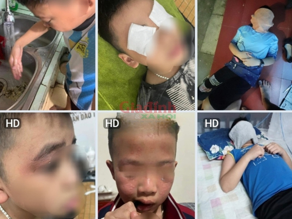Hà Nội: Nhiều học sinh trường tiểu học Hải Bối mẩn ngứa, đau rát mắt sau khi đi học về