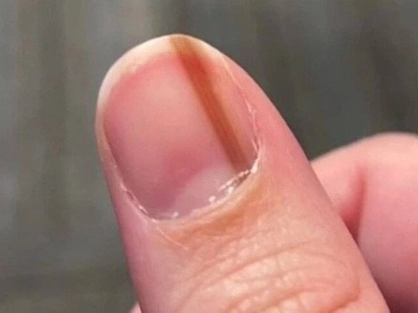 Móng tay xuất hiện sọc đen có phải ung thư da?