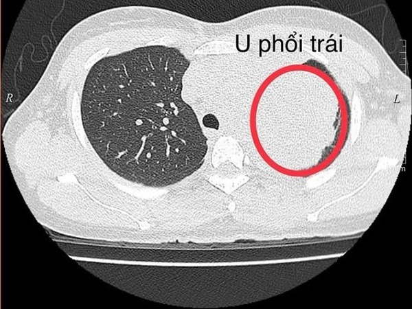 Đi khám vì đau bả vai, người phụ nữ 34 tuổi bất ngờ phát hiện mắc ung thư phổi