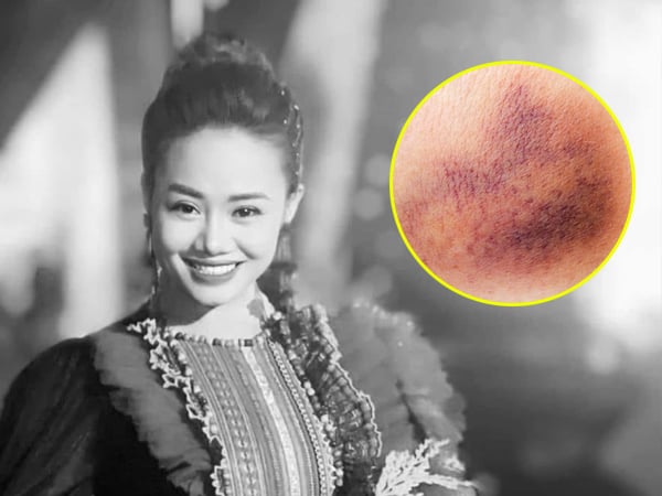 Ca sĩ Lương Ngọc Diệp qua đời ở tuổi 37: Nhận diện vết bầm tím bất thường cảnh báo ung thư