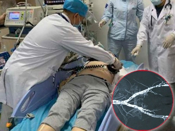 Người đàn ông có mạch máu vôi hóa như ruột bút chì, qua đời vì mê 1 thực phẩm