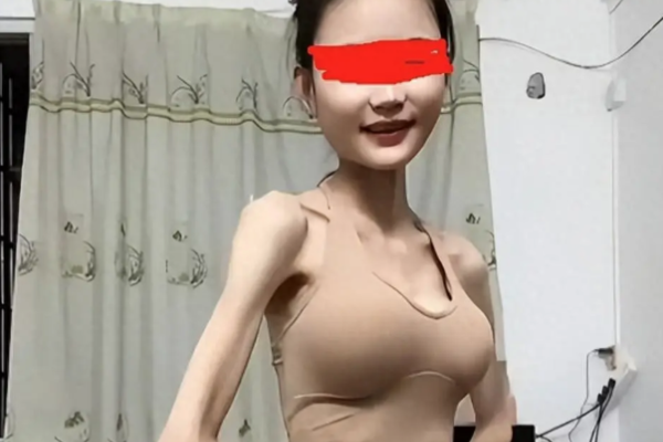 Hoảng hốt với cô gái thân hình mỏng tang vì giảm cân quá đà