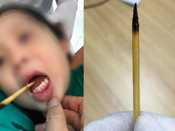 Bé gái 3 tuổi bị que xiên thịt đâm xuyên lưỡi