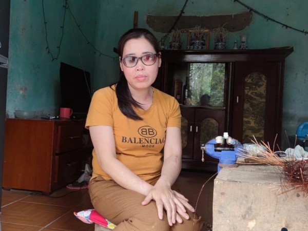 Người phụ nữ bị hãm hại bằng axít: 5 năm 'vết thương cuồng yêu' chưa lành