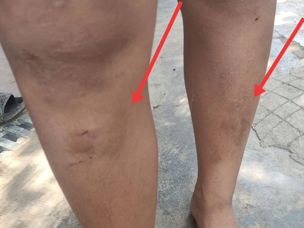 Vụ 5 cháu nhỏ bị hàng xóm đánh bầm dập: Chuyển hồ sơ lên Công an TP Buôn Ma Thuột