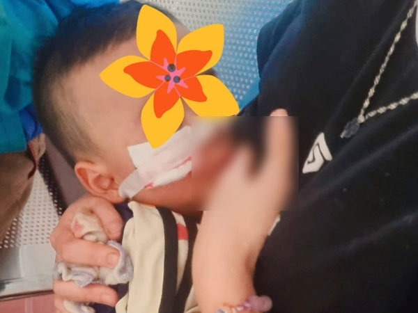 Kinh hoàng em bé 17 tháng tuổi bị trâu húc rách mặt