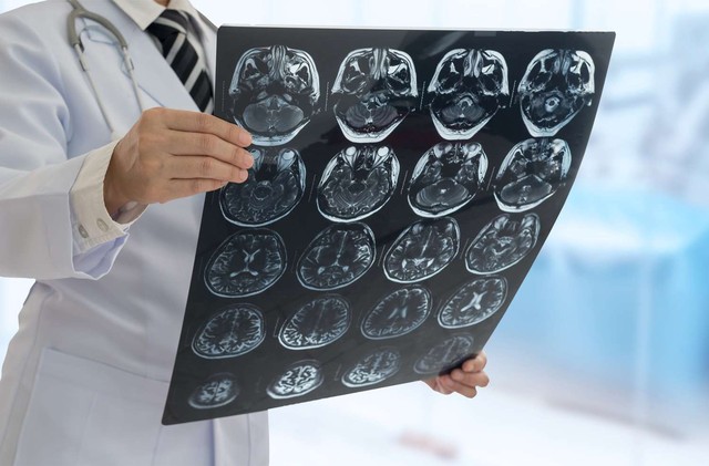 Người đàn ông đột quỵ 3 lần trong 2 năm, hôn mê sâu: BS nói nguyên nhân đến từ 1 sai lầm 'chí mạng'