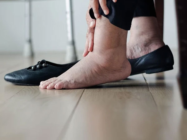 Khi thận suy hỏng, bàn chân có thể xuất hiện 6 điểm bất thường