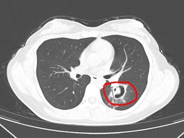 Dọn dẹp tủ quần áo, cô gái 24 tuổi mắc viêm phổi, bác sĩ nhắc 1 việc cần làm