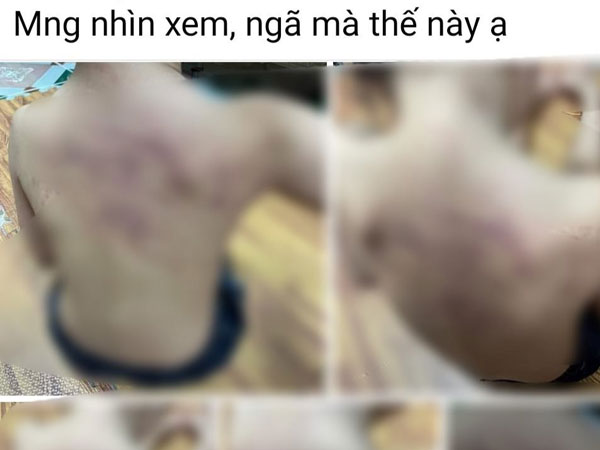 Công an vào cuộc làm rõ vụ học sinh mầm non lớp 5 tuổi bị bầm tím vùng lưng