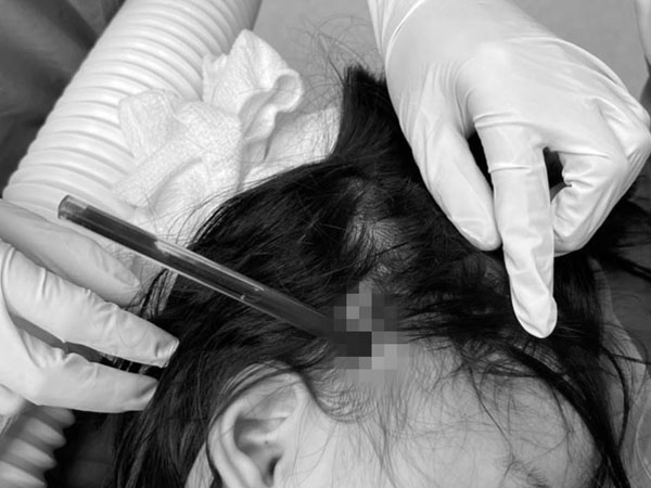 Bé gái 4 tuổi bị bút bi đâm xuyên hộp sọ