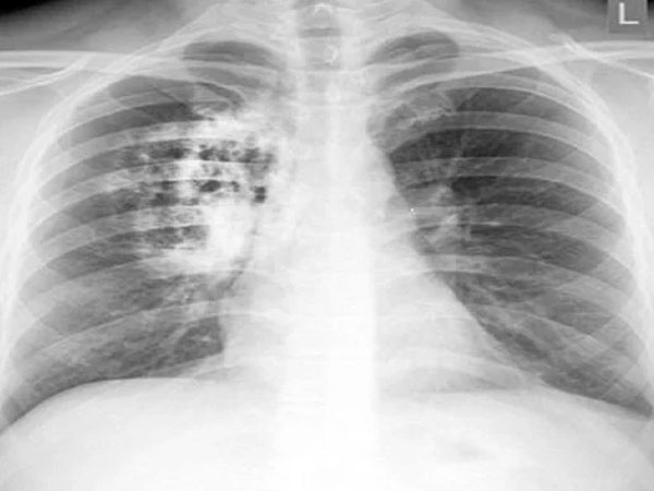 Cô gái 30 tuổi có phổi trắng bất thường như cụ già 80: Bác sĩ nói 'thủ phạm' là 1 thói quen rất hại