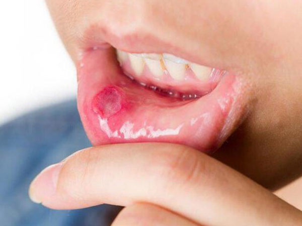 4 dấu hiệu răng miệng cảnh báo ung thư đang đến gần