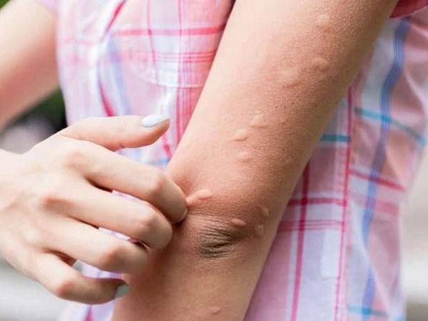 Vì sao bạn bị muỗi đốt nhiều hơn người khác? Có phải 'thịt thơm' là muỗi thích