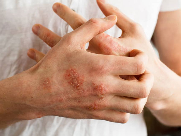 Mẩn ngứa khắp người do nắng nóng, làm gì để phòng tránh?