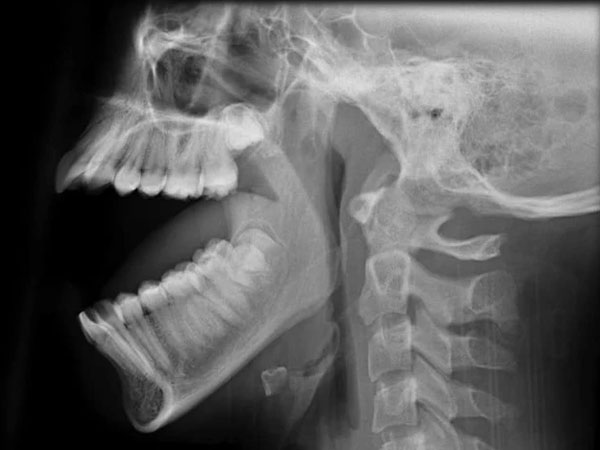 Thanh niên 27 tuổi trật khớp hàm vì… ngáp: Bác sĩ cảnh báo dấu hiệu nguy hiểm