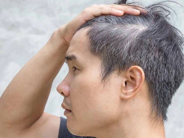 14 cách trị tóc bạc sớm tại nhà hiệu quả nhất với mẹo dân gian