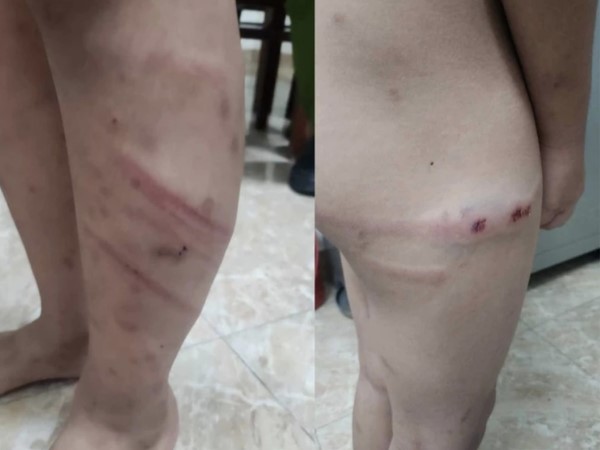 Điều tra vụ việc bé trai 11 tuổi nghi bị mẹ và bạn trai bạo hành dã man