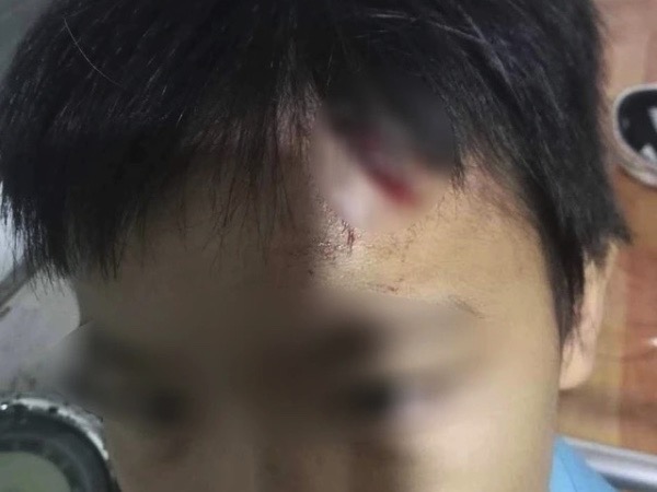 Điều tra vụ bé trai 10 tuổi nghi bị mẹ kế tiếp tục bạo hành