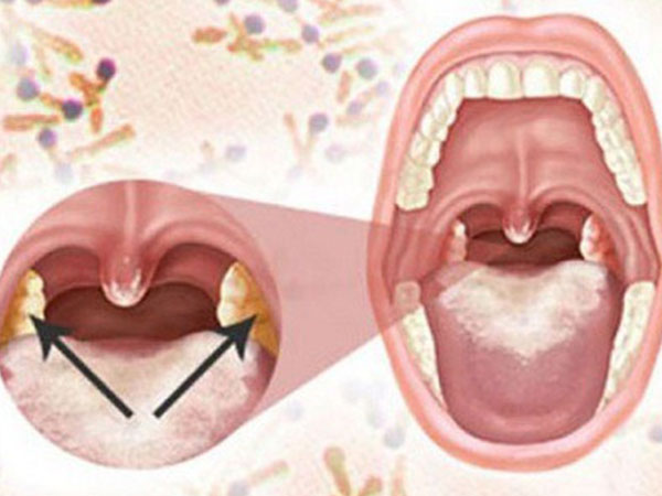 Cô gái 18 tuổi tử vong vì bệnh bạch hầu: Bệnh truyền nhiễm này nguy hiểm thế nào?