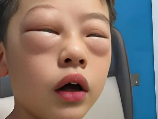 Chuyện thật như đùa: Cậu bé tiểu học 'dị ứng' với bài tập về nhà, cứ mở vở ra là mắt sưng như mắt ếch!