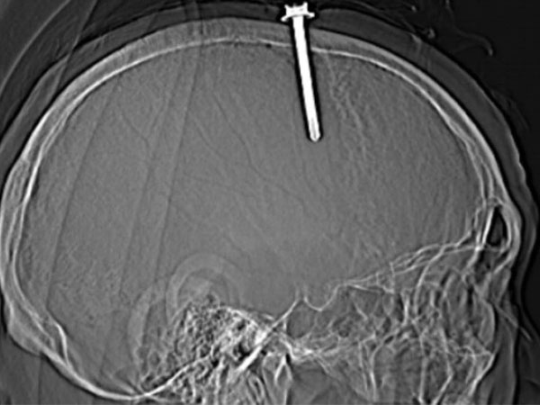 Một người ở Thanh Hóa tự đóng cây đinh dài 5 cm vào đầu mình
