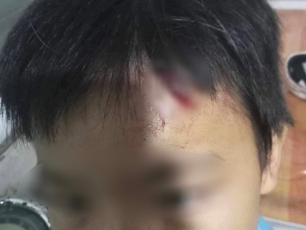 Diễn biến nóng vụ bé trai 10 tuổi nghi bị mẹ kế bạo hành