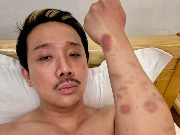 Trấn Thành người đầy thương tích