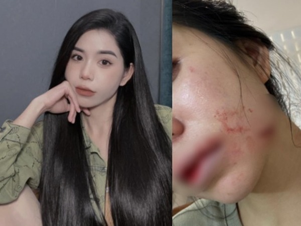Vụ Hằng Du Mục bị bạo hành: Người chồng được tại ngoại sau 2 ngày gây ra chuyện phẫn nộ