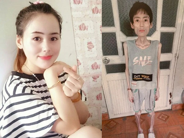 Cô gái Hưng Yên chỉ nặng 19kg vì nhịn cơm giảm cân: Từng 54kg, xinh gái có tiếng, hé lộ căn bệnh mắc phải