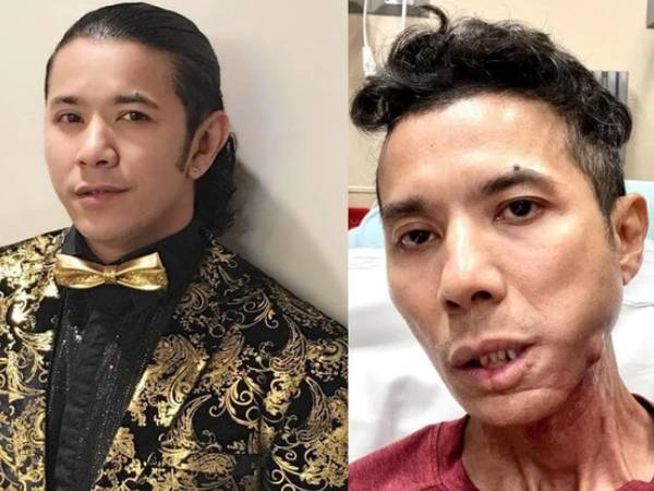 Ca sĩ Kasim Hoàng Vũ mắc bệnh gì?