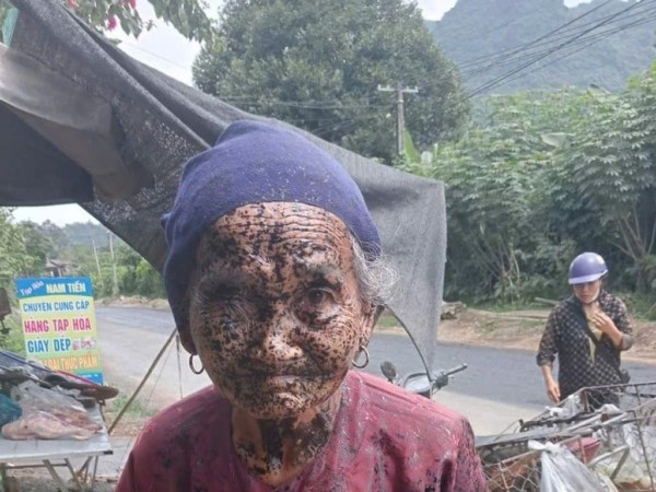 Thanh Hóa: Cụ già bị đơn vị thi công phun nhựa đường vào mặt