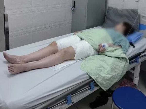 Hút mỡ đùi, người phụ nữ bị hoại tử nghiêm trọng