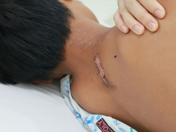Cứu sống bé trai ngưng thở, ngưng tim 15 phút do bị sét đánh