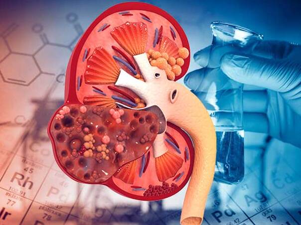 Ăn rau rất tốt nhưng có 3 loại rau càng ăn nhiều càng dễ sỏi thận, suy thận, loại cuối cùng người Việt rất hay sử dụng