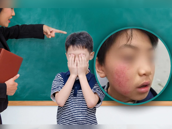 Mẹ tố con trai mất sắc tố da vì bị giáo viên liên tục tát vào mặt