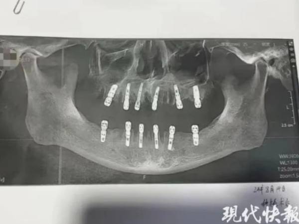 Tử vong vì nhổ và trồng gần 40 chiếc răng trong một ngày