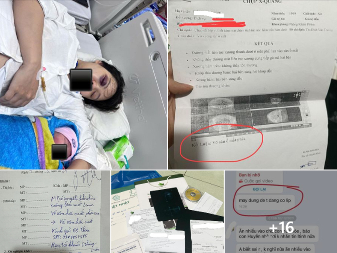 Vụ bạo hành chấn động: Vợ bầu 39 tuần bị chồng tác động gãy sàn ổ mắt và đằng sau là câu chuyện 5 tháng hôn nhân địa ngục
