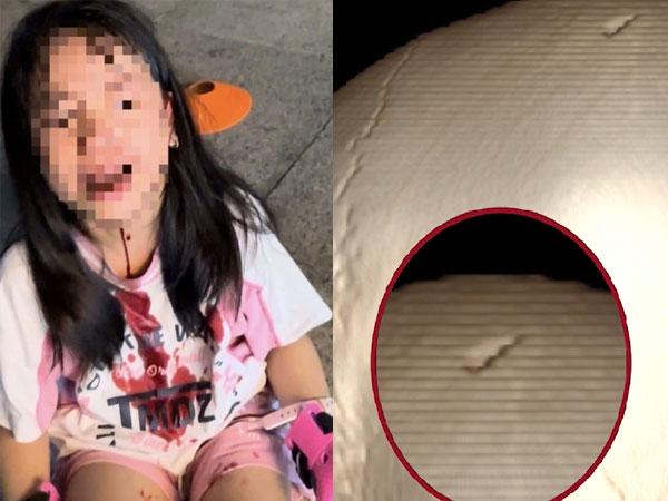 Ngồi chơi ở sân chung cư, bé gái Hà Nội bị vật cứng rơi trúng đầu, lõm sọ não nghiêm trọng
