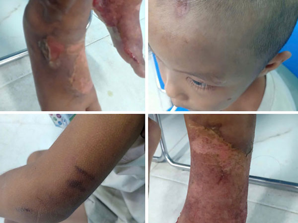Bé trai 6 tuổi bị nhốt trong phòng trọ, cơ thể loang lổ nhiều vết bỏng đang lở loét, nghi bị bạo hành