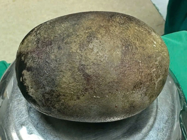Bác sĩ ngỡ ngàng trước khối sỏi nặng tới 700g nằm trong bàng quang của nam bệnh nhân