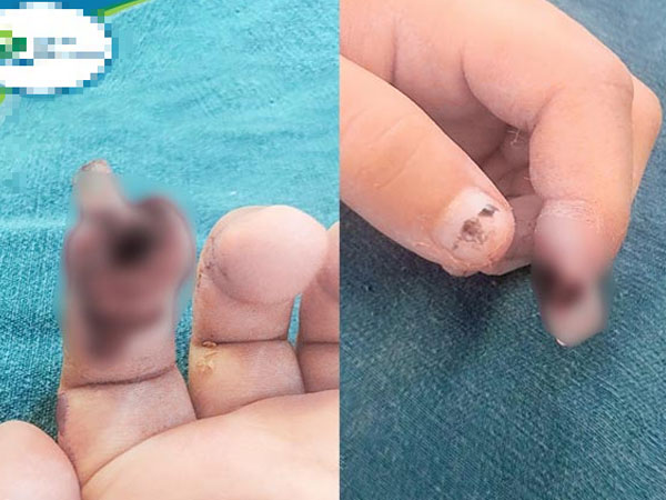 Kẹp tay vào cửa kính thủy lực ở siêu thị, bé 3 tuổi bị đứt ngón tay