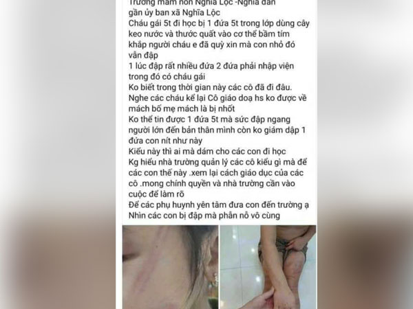 Nhiều trẻ mầm non bị bạn đánh bầm tím cơ thể tại lớp học